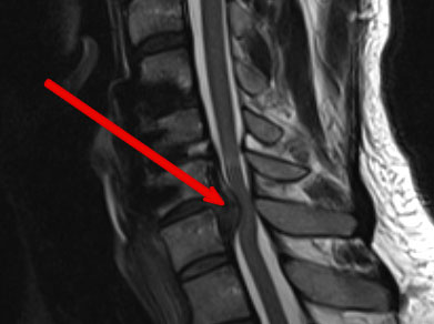 large, compressing, herniated disc