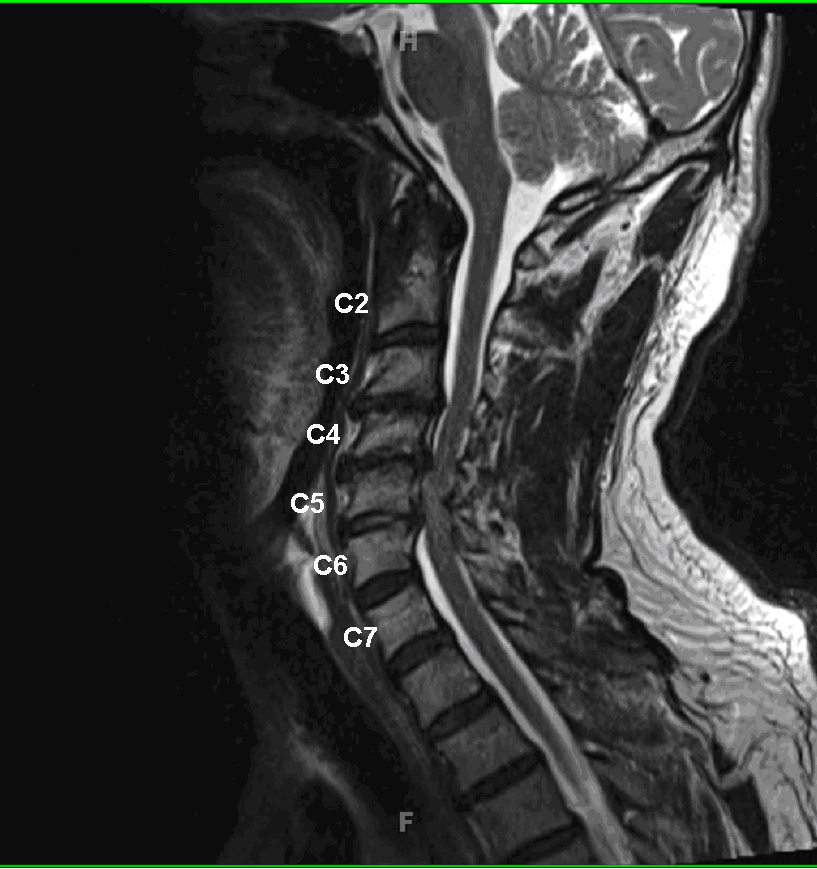 multiple herniations compressing cord