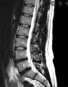 An MRI scan of a spine