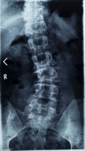 An x-ray of a spine