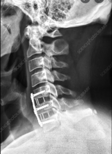 A cervical spine MRI scan