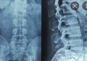 An x-ray result of a spine and hip bone