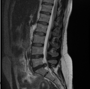 A CT scan of a spine