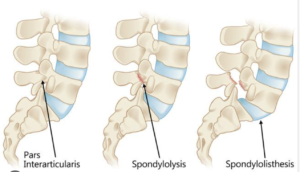 A Spondylosis condition
